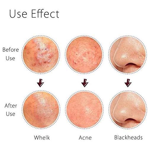 FEITA Blackhead Remover Kit, 5 Count