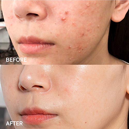 SOME BY MI Aha Bha Pha 14 Days Super Miracle Spot All Kill Cream, 30 ml