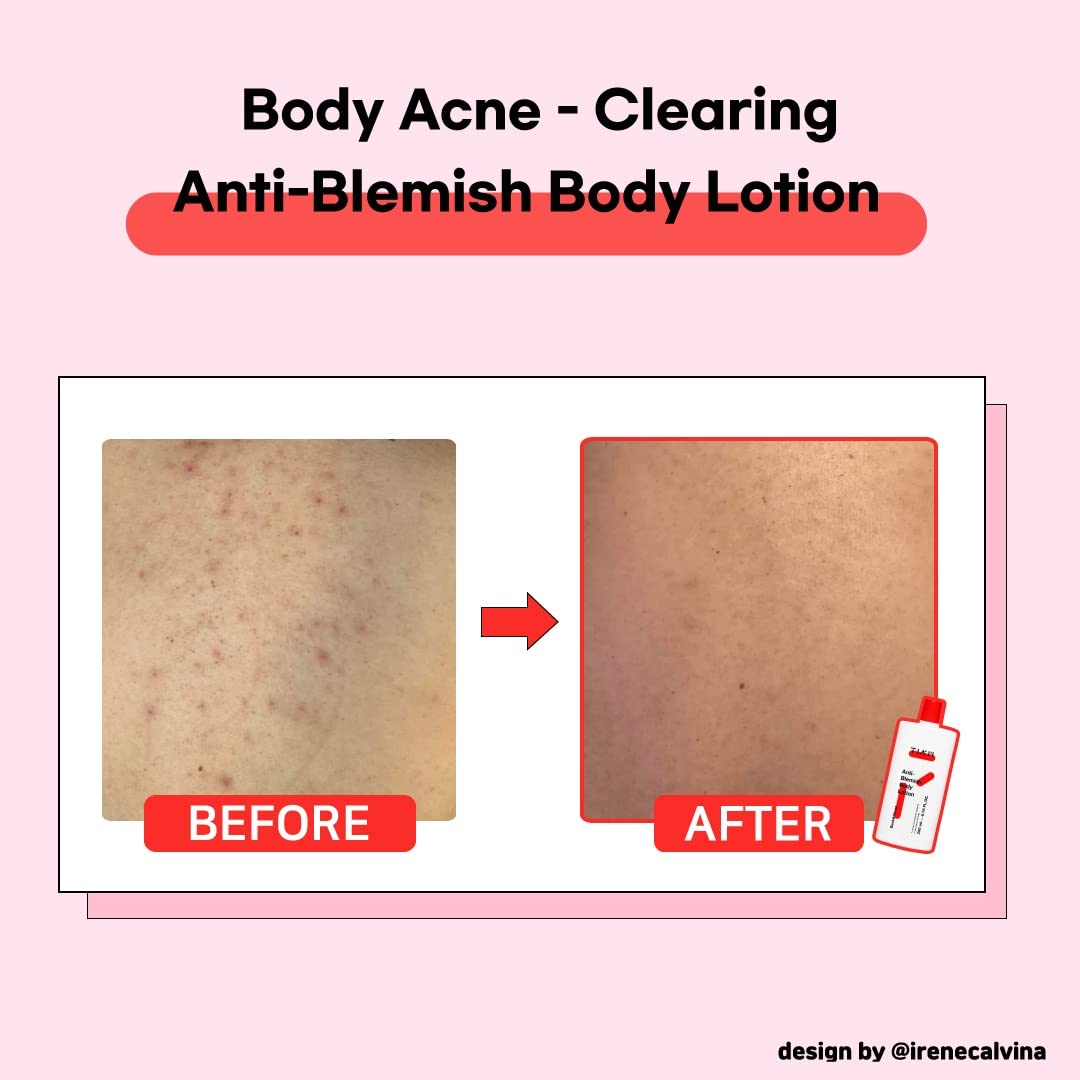 TIAM Anti-Blemish Body Lotion, 6.76 fl oz