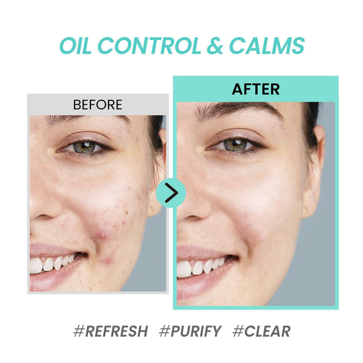 Coxir Tea Tree Pore & Sebum Emulsion