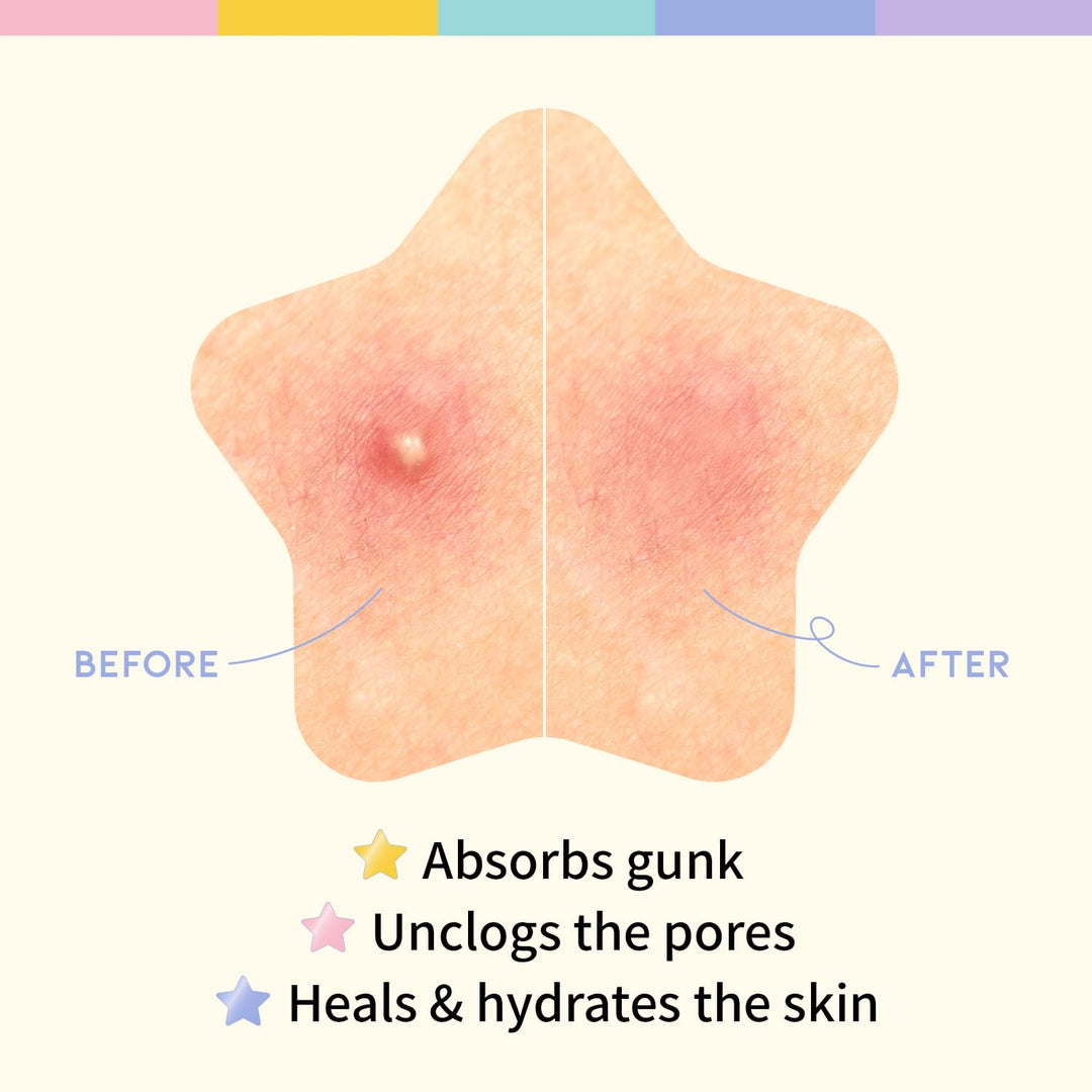 #OOTD Pastel Star Pimple Patches, 80 Count