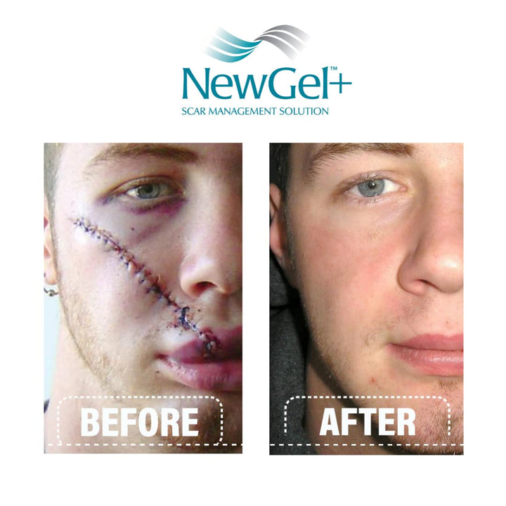 MyNewGel Scar Gel With Vitamin E, 1 oz