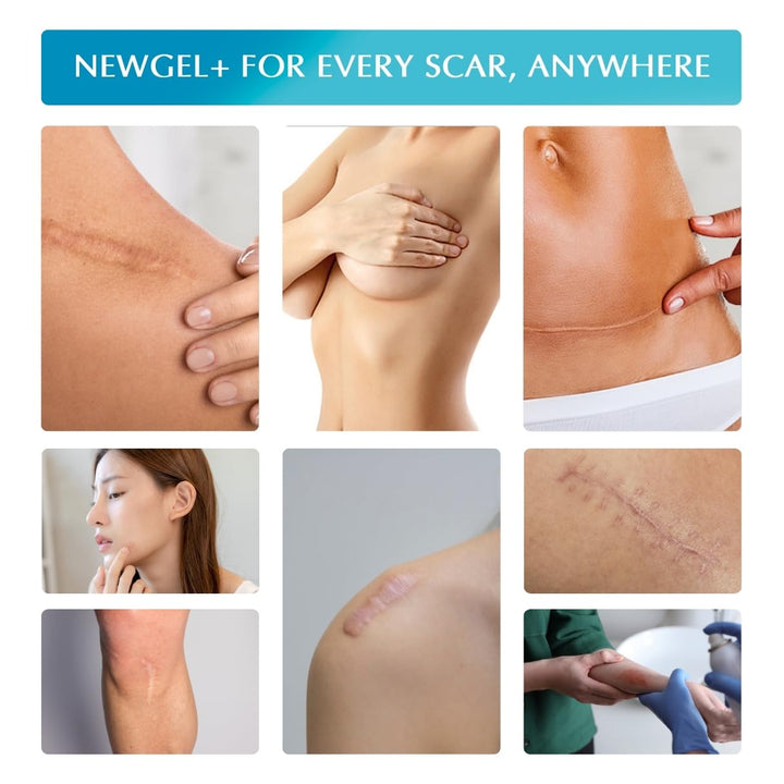 MyNewGel Advanced Silicone Scar Treatment Sheets, Clear, 1 in x 6 in, 4 Count