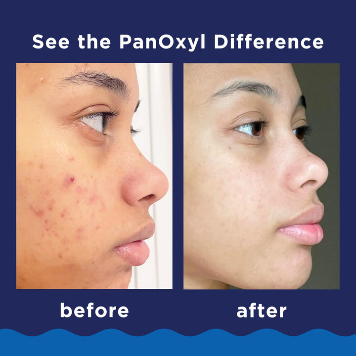 PanOxyl Acne Foaming Wash, 10%, 5.5 oz