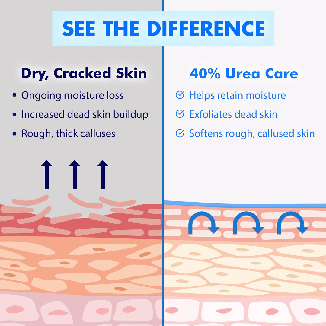 Ebanel Urea Cream 40 Percent Plus Salicylic Acid 2 Percent