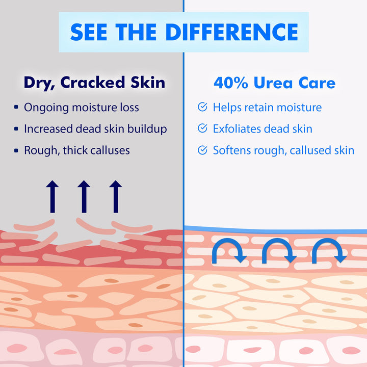 Ebanel Urea Cream 40 Percent Plus Salicylic Acid 2 Percent