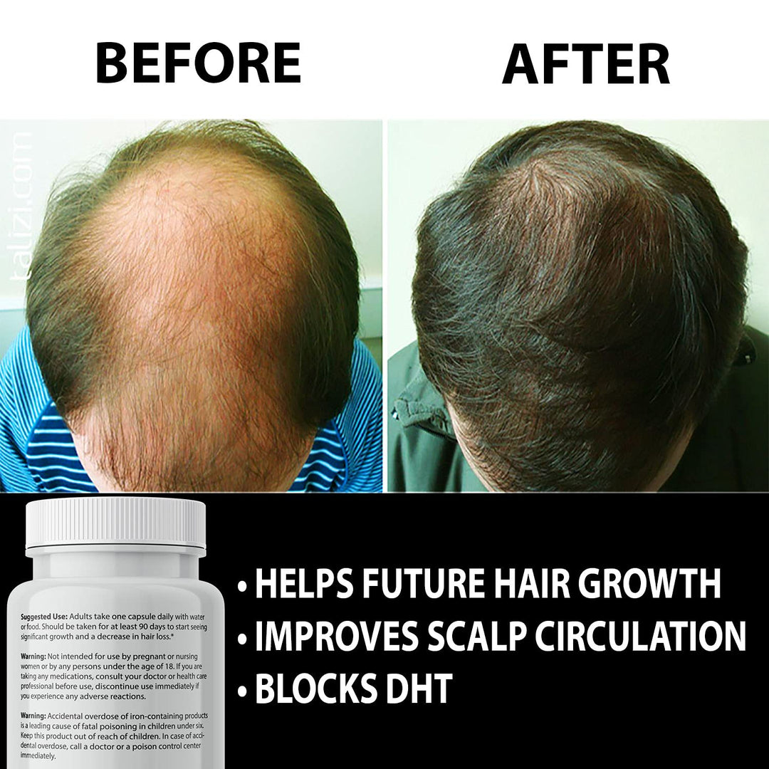 IXYAY RESEARCH Finanutride DHT Blocker Hair Growth Capsules