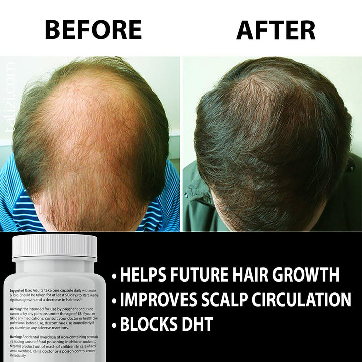 IXYAY RESEARCH Finanutride DHT Blocker Hair Growth Capsules