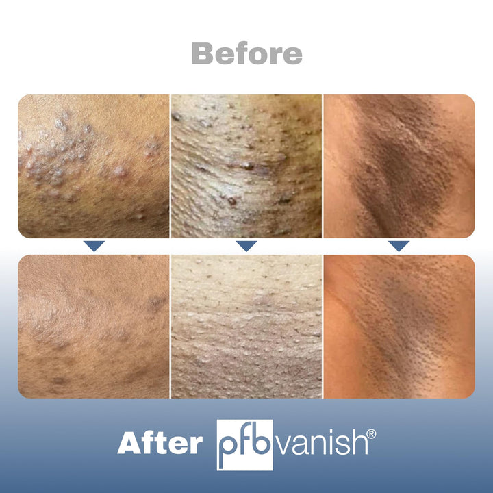 PFB Vanish Ultra Triple Action Skin Lightening Serum, 93 g