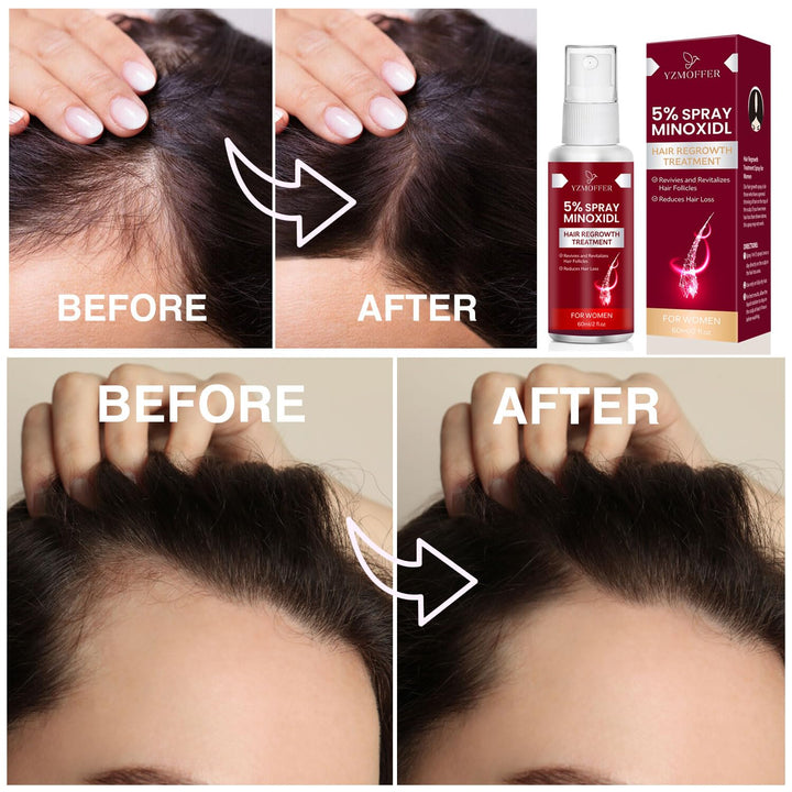 Yzmoffer Minoxidil Hair Growth Spray, 5%, 56 ml