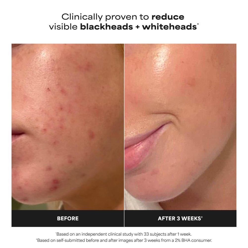 PAULA'S CHOICE Skin Perfecting 2% BHA Liquid Exfoliant, 118 ml