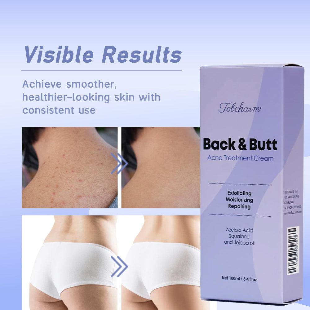 Tobcharm Butt Acne Clearing Treatment, Maximum Strength
