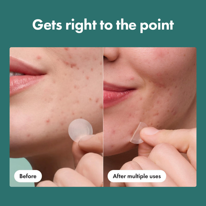 Mighty Patch Micropoint Acne Pimple Patches, 8 Count