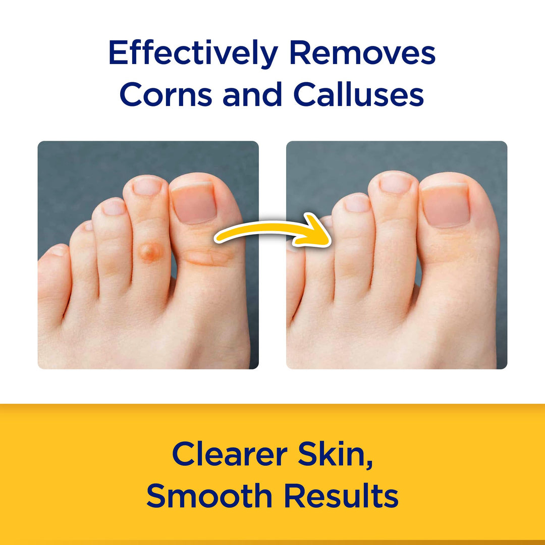 EasyComforts Corn Remover Stick, Maximum Strength, 0.2 oz