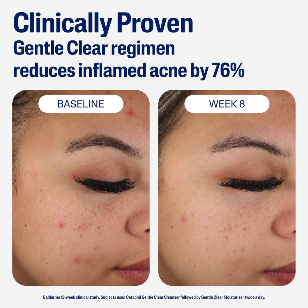 Cetaphil Acne Face Moisturizer, 89 ml