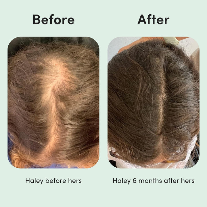 HIMS & HERS Hair Regrowth Treatment, Unscented, 4 Month Supply