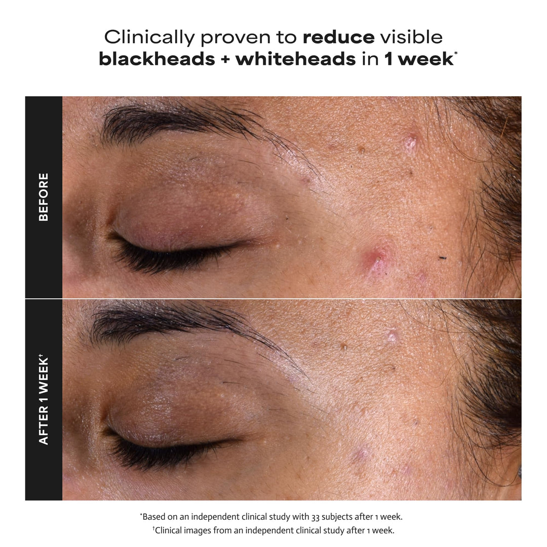 PAULA'S CHOICE Skin Perfecting 2% BHA Liquid Exfoliant, 118 ml