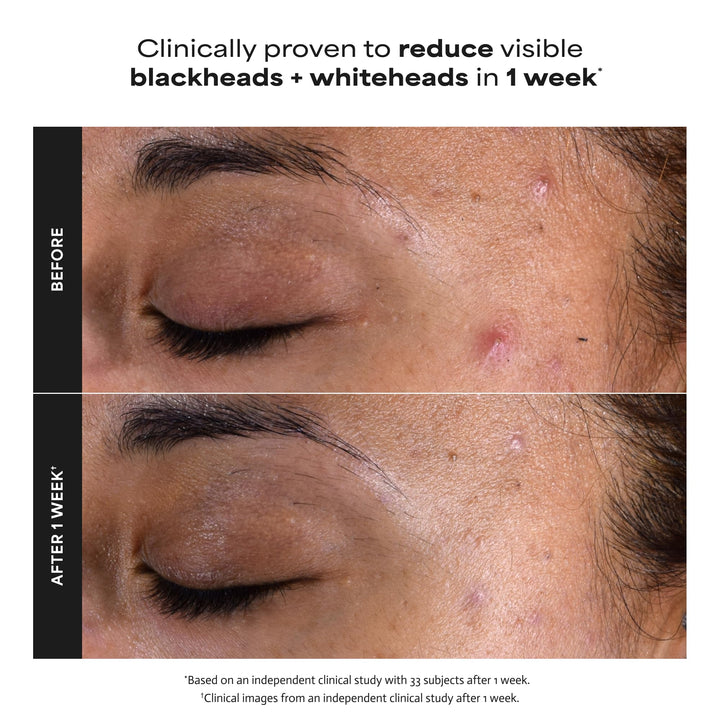 PAULA'S CHOICE Skin Perfecting 2% BHA Liquid Exfoliant, 118 ml