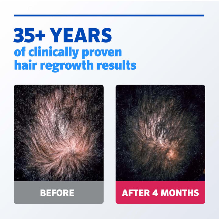 Rogaine Hair Regrowth Treatment, Topical Solution, 60 ml