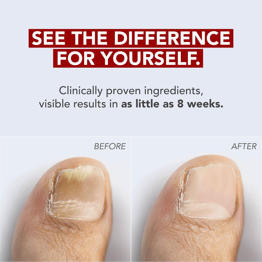 Kerasal Nail Fungus Treatment, Extra Strength, 0.33 fl oz, Pack of 2