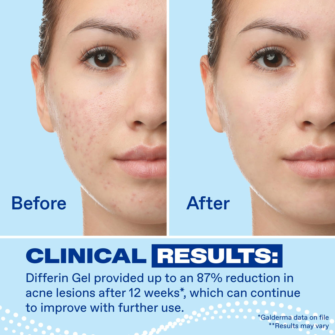 Differin Acne Treatment Gel, 0.1% Adapalene, 45 g