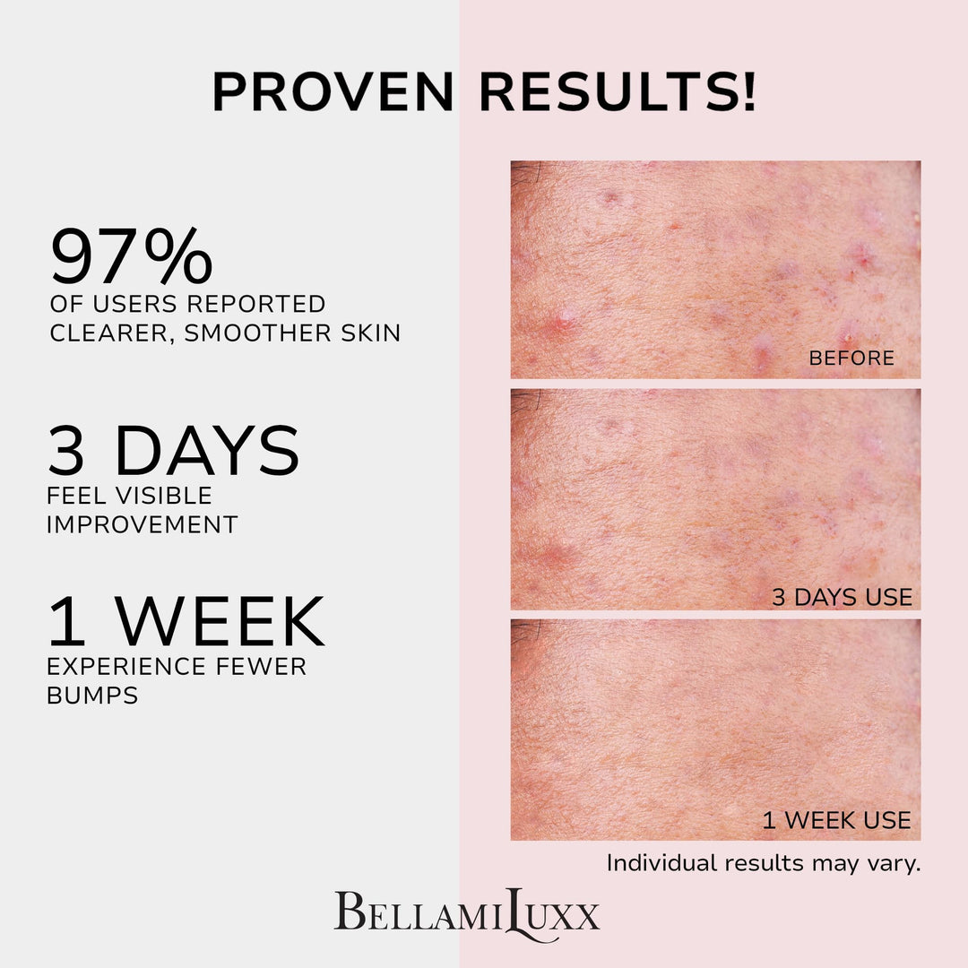 BellamiLuxx Butt Acne Clearing Lotion